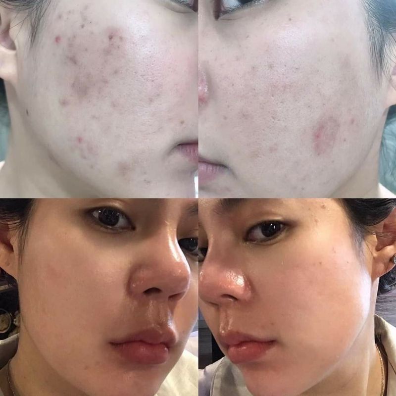 [Mẫu mới] Kem nám Cosmelan2 - Chuyên về nám mảng ,nám chân sâu , đốm nâu , tàn nhang , đồi mồi , da không đều màu | BigBuy360 - bigbuy360.vn