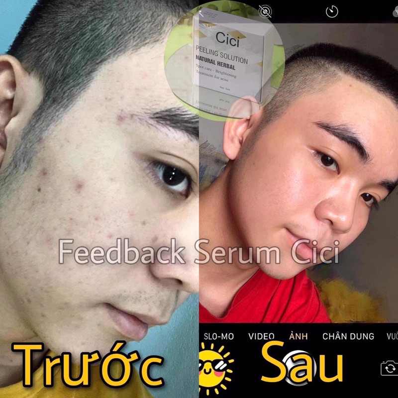 HỘP SERUM MỤN🌱