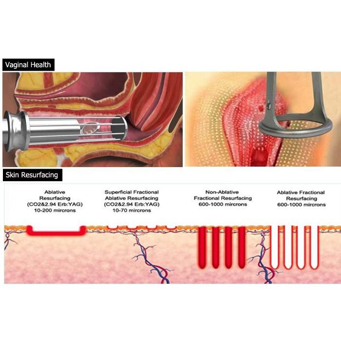 MÁY LASER FRACTIONAL CO2