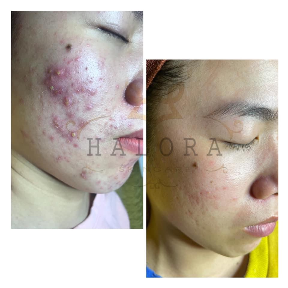 Serum Mụn Haloro Giúp Ngăn Ngửa Các loại Mụn, Dị Ứng Da, Thâm Sạm Nám [ CHÍNH HÃNG] Liệu Trình Chăm Sóc Da Mụn Tại Spa | BigBuy360 - bigbuy360.vn