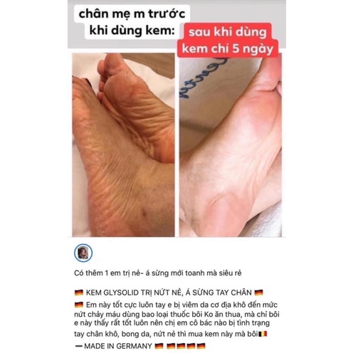 Kem dưỡng glysolid chăm sóc cho gót chân bị nứt nẻ, vẩy nến, á sừng
