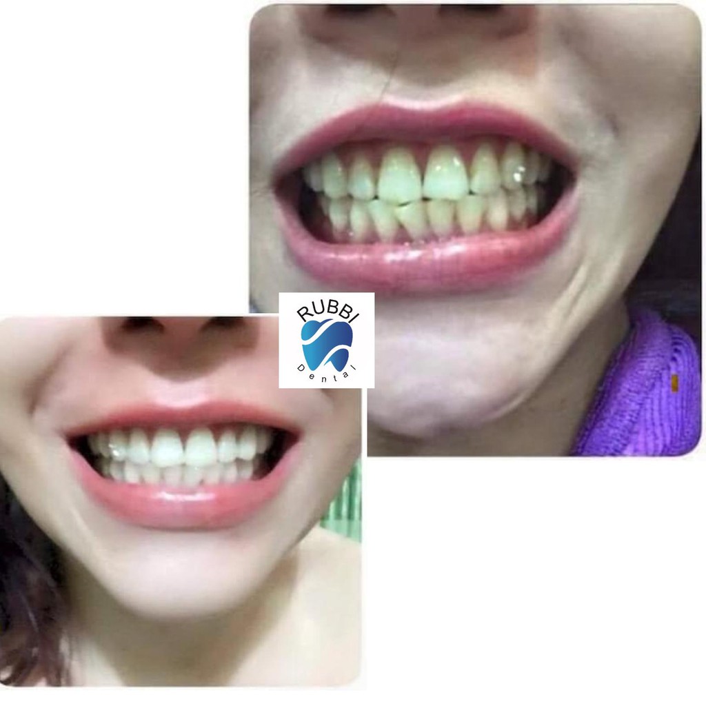 Miếng dán trắng răng 3D,5D white teeth whitening trắng răng bật tông trong 7 ngày sử dụng