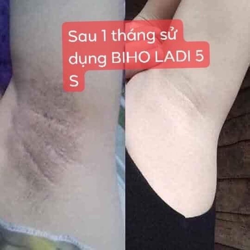 BIHO_LADI SIÊU DƯỠNG THÂM 5S KHỬ THÂM NÁCH, THÂM MÔNG, THÂM BIKINI SIÊU DƯỠNG THÂM 5S (BIHO_LADY)