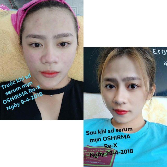 SERUM NGỪA MỤN MỜ THÂM OSHIRMA10gr