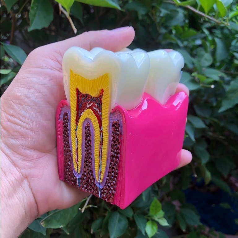 Mô hình nha khoa giải phẫu phóng đại bệnh lý sâu răng,mô hình răng sâu phóng đại x6 lần ,dụng cụ hỗ trợ học nha khoa