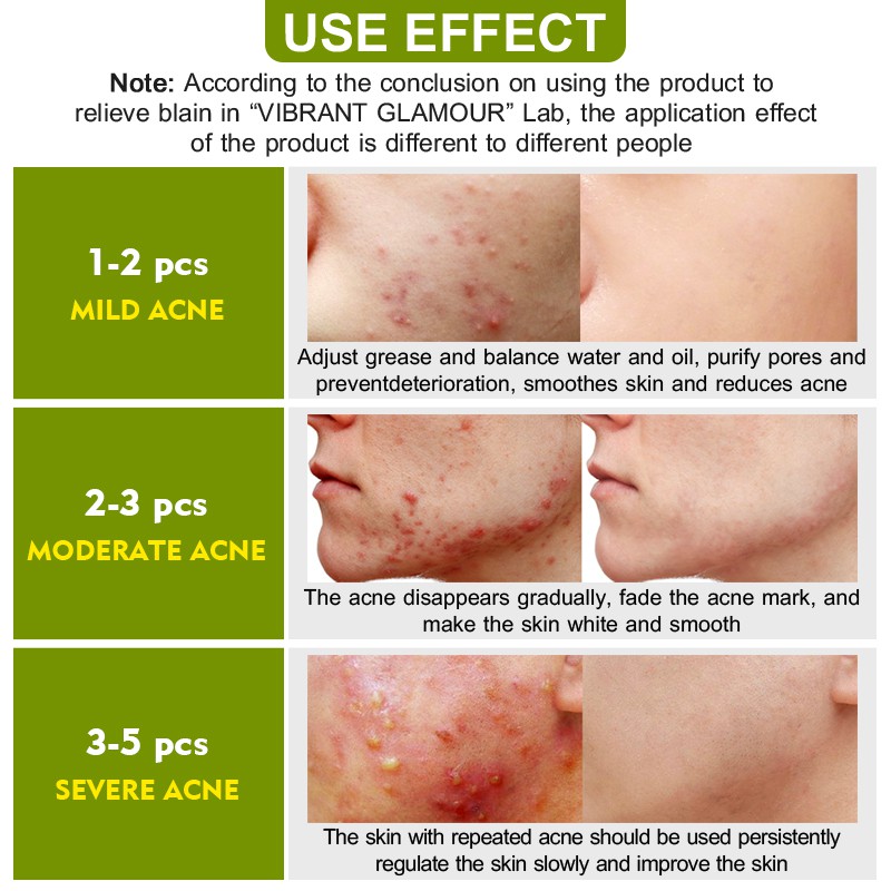 Set 3 sản phẩm VIBRANT GLAMOUR chiết xuất tràm trà cải thiện sẹo/mụn trứng cá chăm sóc da | BigBuy360 - bigbuy360.vn