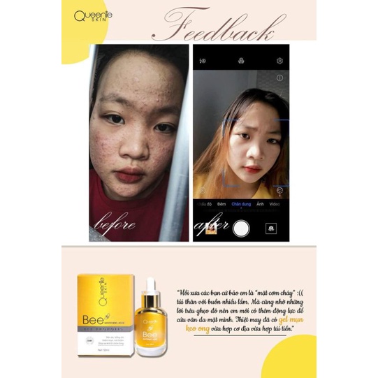 KEM FACE MỤN , LÀM SÁNG DA QUEENIE SKIN | BigBuy360 - bigbuy360.vn