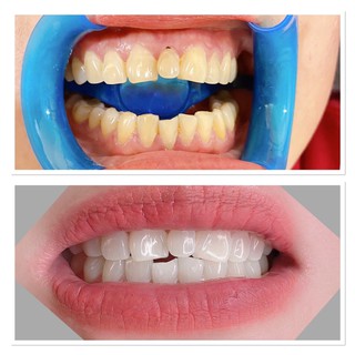 Voucher trắng răng công nghệ Laser whitening