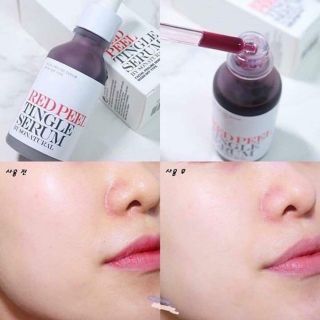 Serum Red Peel thay da sinh học thế hệ mới Sonatural