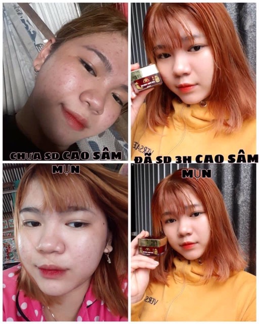 CAO MỤN SÂM ĐỎ FULLBOX 15GR | BigBuy360 - bigbuy360.vn