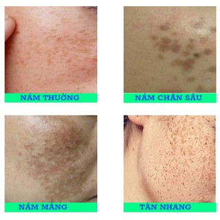 Sét nám đỏ 𝐝𝐮̛𝐨̛̃𝐧𝐠 𝐭𝐫𝐚̆́𝐧𝐠 𝐝𝐚 Thái lan