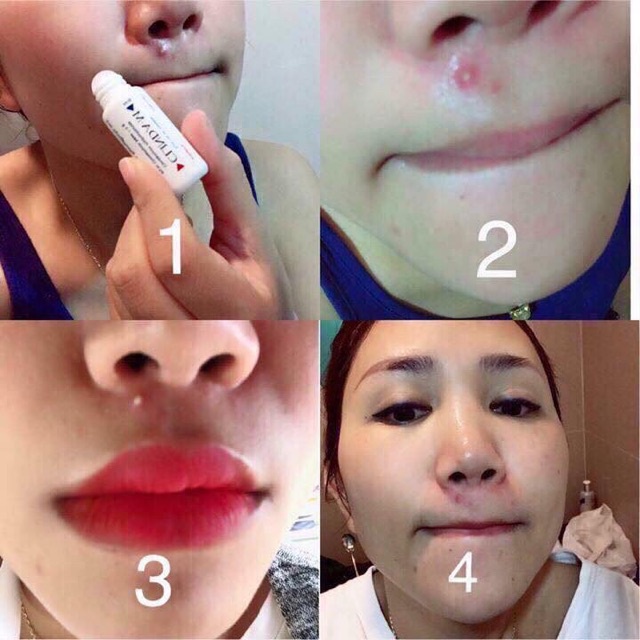 Gel Chấm Các Loại Mụn Clinda-M Thái Lan