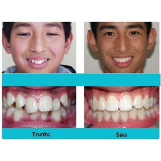MÁNG NIỀNG RĂNG TRAINER 2 GIAI ĐOẠN