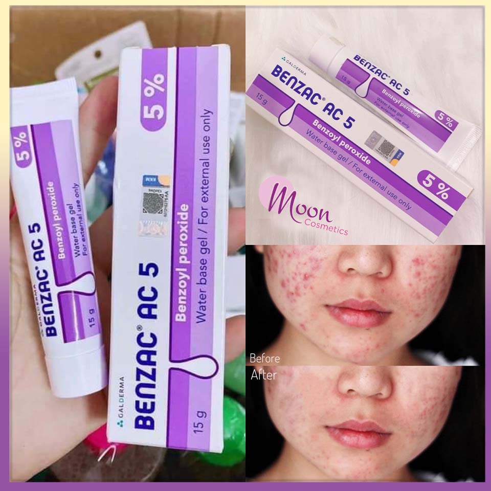 Kem ngừa mụn Benzac AC 5 5% Benzoyl Peroxide - Galderma