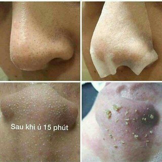 SERUM Ủ MỤN HÀN QUỐC OHIO