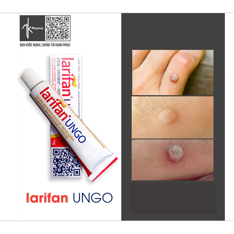 Kem Tẩy Mụn Cóc Larifan Ungo 10g