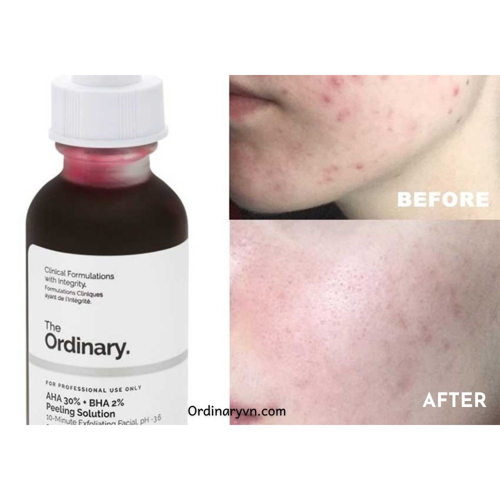 Tẩy da chết AHA 30% + BHA 2% Peeling Solution The Ordinary - Family Cosmetics