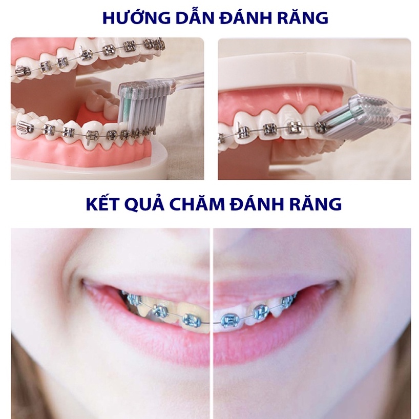 Bàn Chải Đánh Răng Cho Người Niềng Răng Trisa Bracket Clean