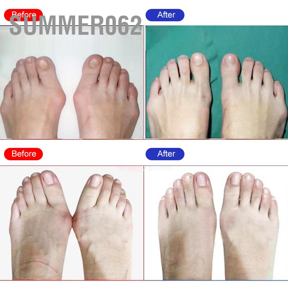 Đai đeo tách chỉnh sửa ngón chân cải thiện tình trạng biến dạng ngón chân cái sử dụng ngày/ đêm mang giày được unisex