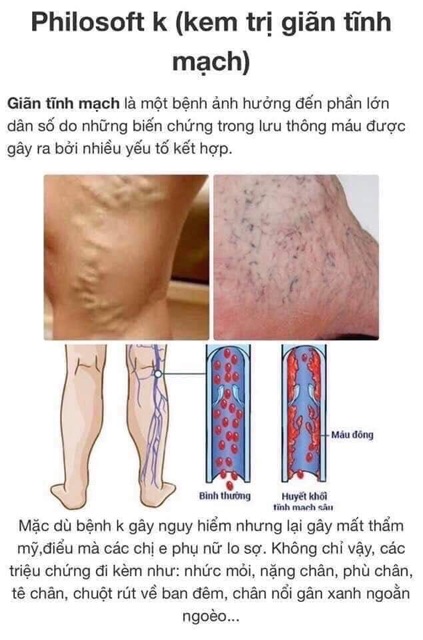 Kem trị suy giãn tĩnh mạch thái lan