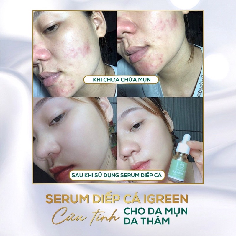 Combo 2 Sản Phẩm, Serum Diếp Cá Và Sữa Rửa Mặt Diếp Cá, Cải Thiện Làn Da Sau 7 Ngày