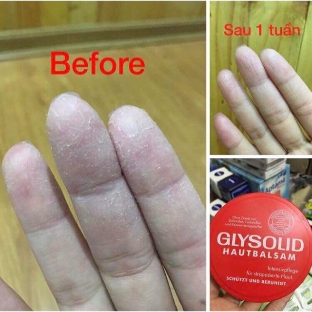 Kem dưỡng da Glysolid của Đức !!!
