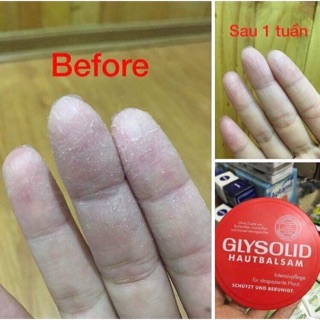 Kem dưỡng da Glysolid của Đức !!!