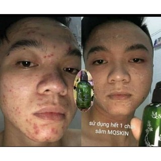 Nhân Sâm Thay Da MQ SKIN 80ml