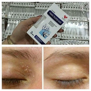 Tẩy nốt RUỒI NGA