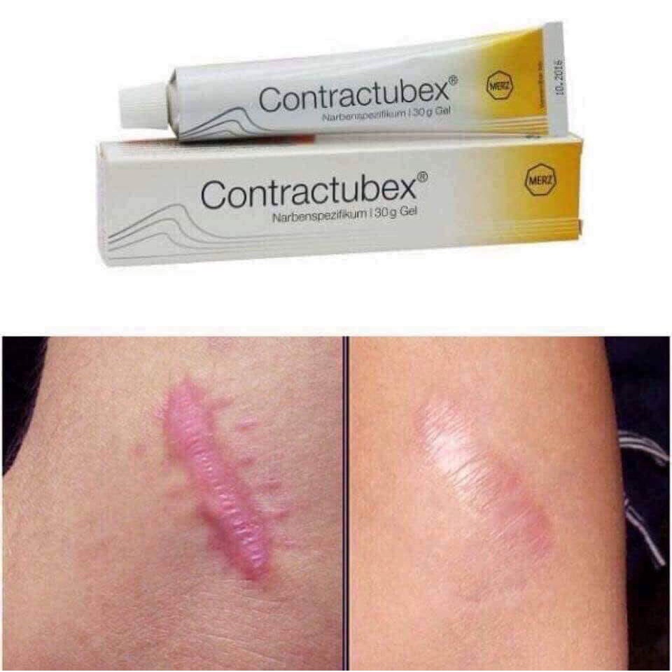 Kem mờ sẹo lồi, thâm Contractubex Đức 30g dạng gel, làm mềm mô sẹo - Shop Viloet