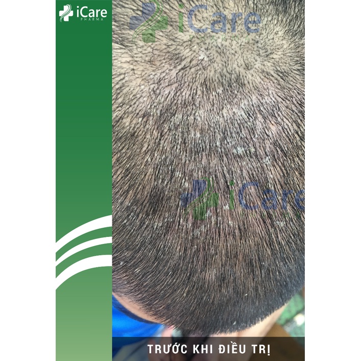 Combo Ezema 50 &amp; Dầu Gội Sạch Gàu Antisol - Hiệu Quả Nhanh Chóng, Chiết Xuất Gurjun Ấn Độ SACUCO