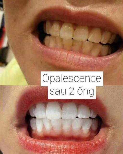 Thuốc ngậm trắng răng Opalescence 20%