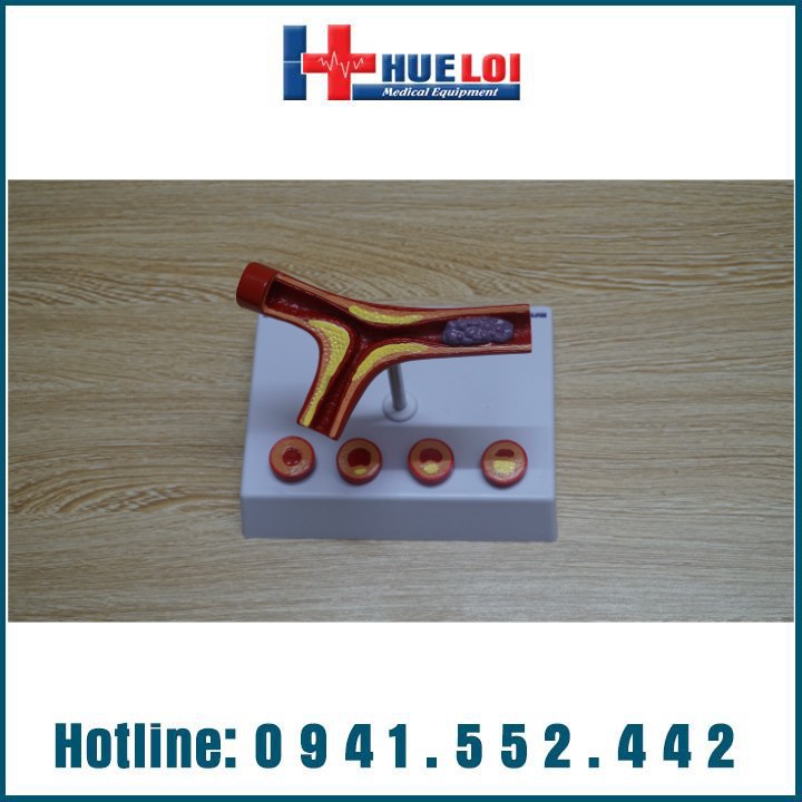 MÔ HÌNH XƠ VỮA KÈM HUYẾT KHỐI ĐỘNG MẠCH VÀNH