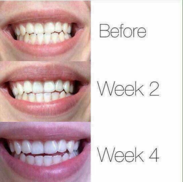 KEM TẨY TRẮNG RĂNG