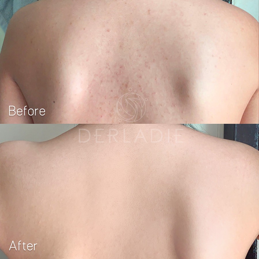 Xà Phòng Giảm Mụn Cơ Thể, Mụn Lưng Derladie Body Cleansing Bar For Blemish Skin 50g + Tặng Kèm 1 túi lưới tạo bọt | BigBuy360 - bigbuy360.vn