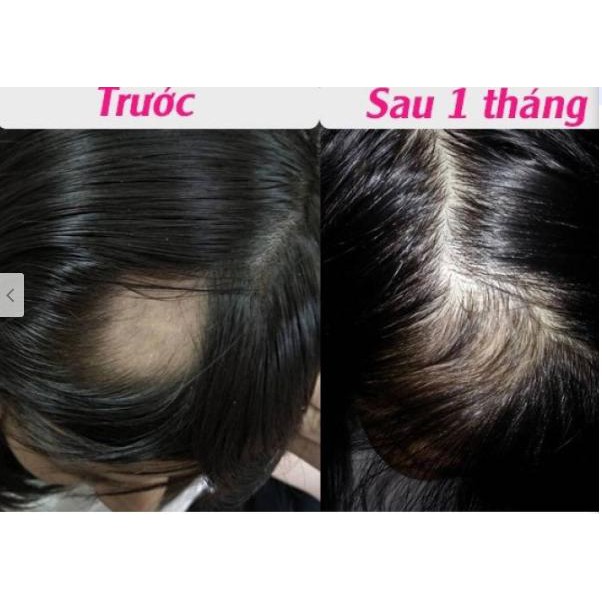 Bộ dầu gội xả thuốc Bách Niên Xuân trị rụng tóc bạc tóc - m213 Giảm 50%