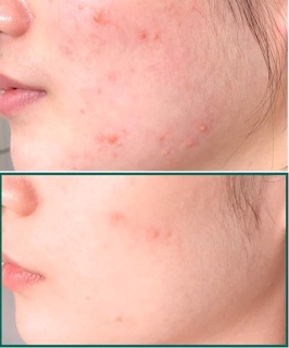 SỮA RỬA MẶT SOME BY MI AHA-BHA-PHA 30 DAYS MIRACLE