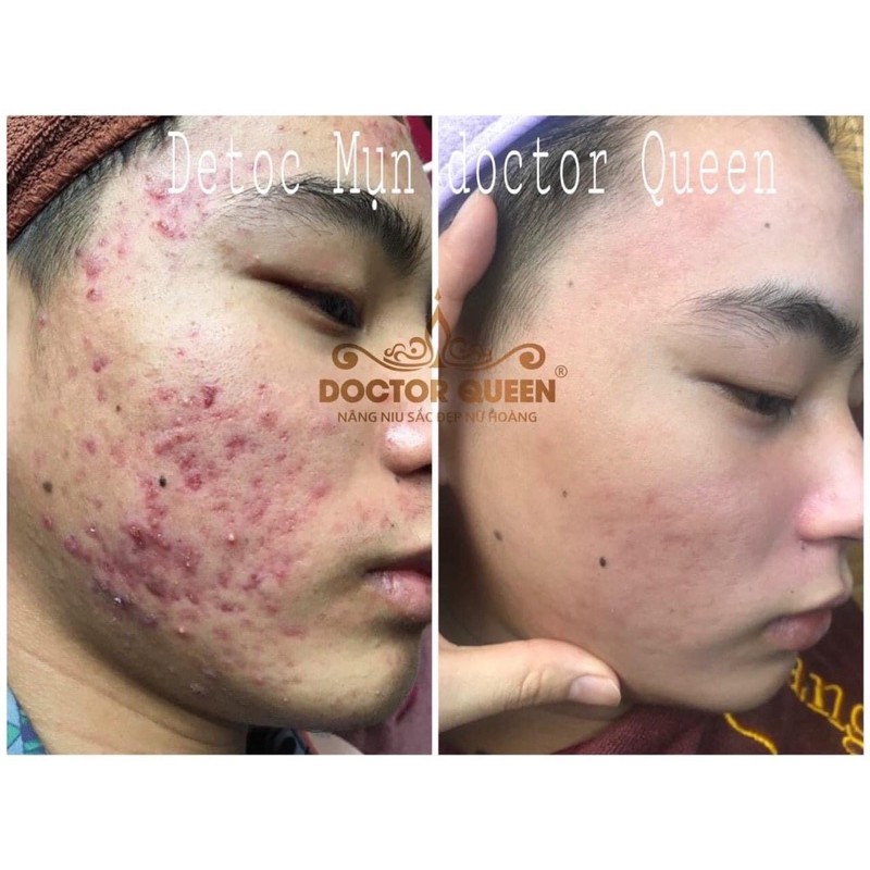 serum tri mụn doctor queen