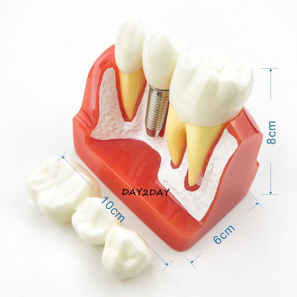 MÔ HÌNH TƯ VẤN SO SÁNH IMPLANT VÀ CẦU RĂNG - MÔ HÌNH TƯ VẤN NHA KHOA - MẪU HÀM 2017