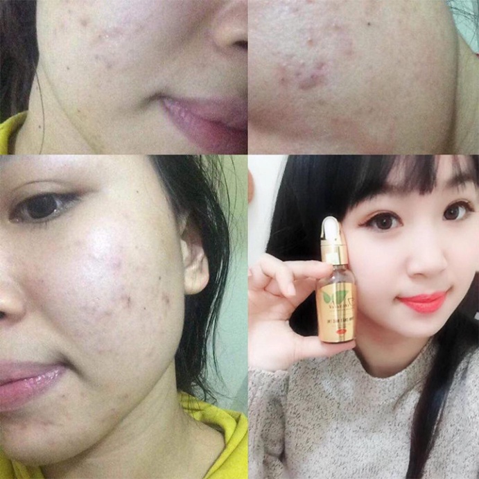 TINH CHẤT SERUM TAVIDA DÀNH CHO DA MỤN THÂM NÁM | BigBuy360 - bigbuy360.vn