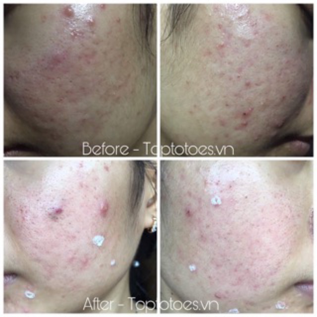 Serum Teana Super Peptides NO PROBLEM INTENSIVE CARE SERUM loại bỏ m.ụn gom cồi se khít chân lông | BigBuy360 - bigbuy360.vn