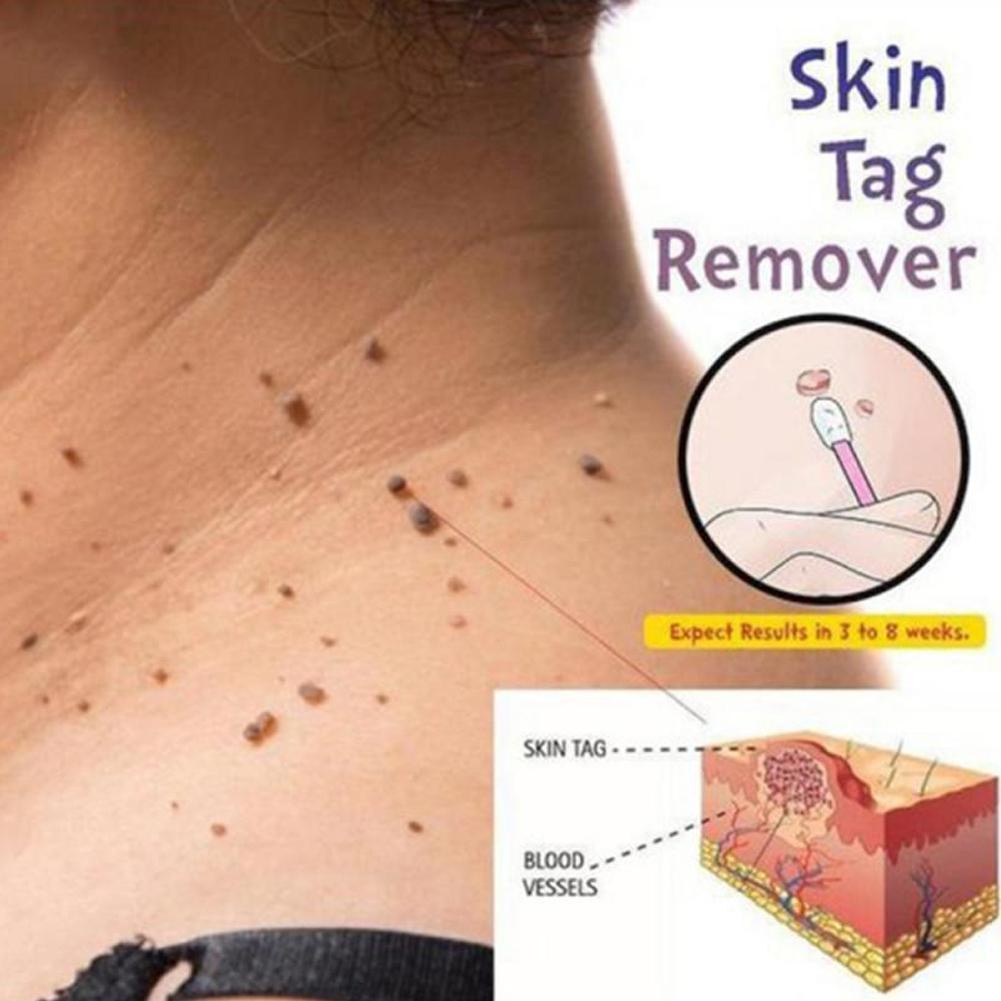 Dung Dịch Loại Bỏ Mụn Thịt Dư Trên Da M8H7