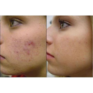 Kem Chấm Mụn AcneFree Terminator 10 Acne Spot Treatment with 10% Maximum Strength Benzoyl Peroxide (bill Mỹ)