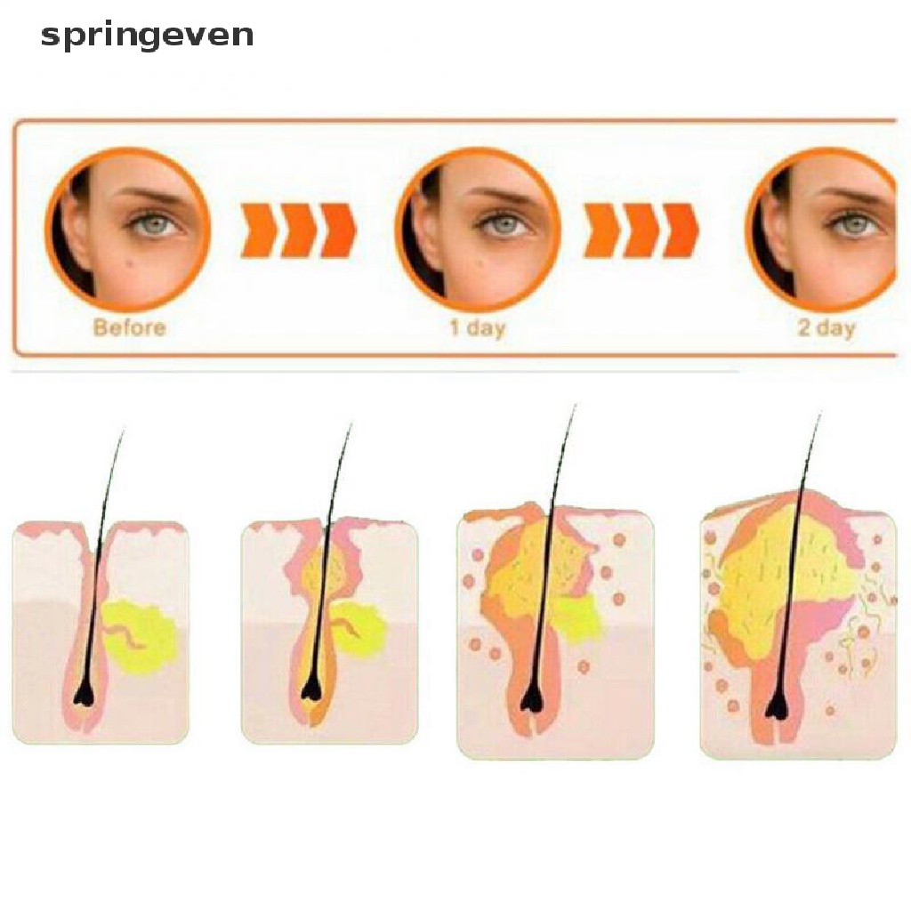 Bộ 36 Miếng Dán Mụn Hydrocolloid Và Mụn Thịt springeven  Máy Hút Bụi Cầm Tay
