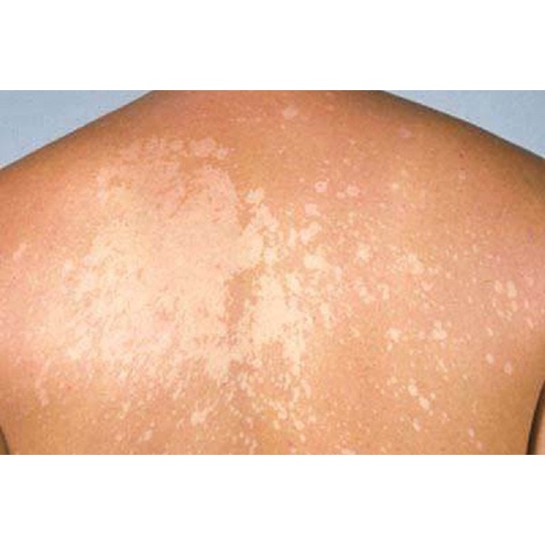 Kem bôi bạch bến nấm ngứa hắc lao