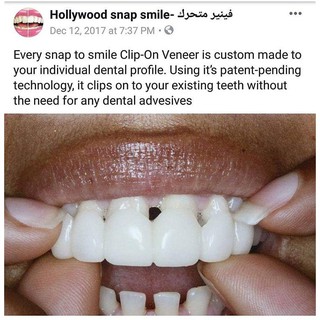 [2020] Dụng cụ răng thẩm mỹ Snapon Smile - nẹp răng
