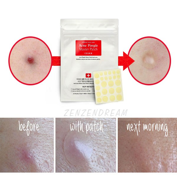 Miếng dán mụn trứng cá Cosrx Acne Pimple Master Patch