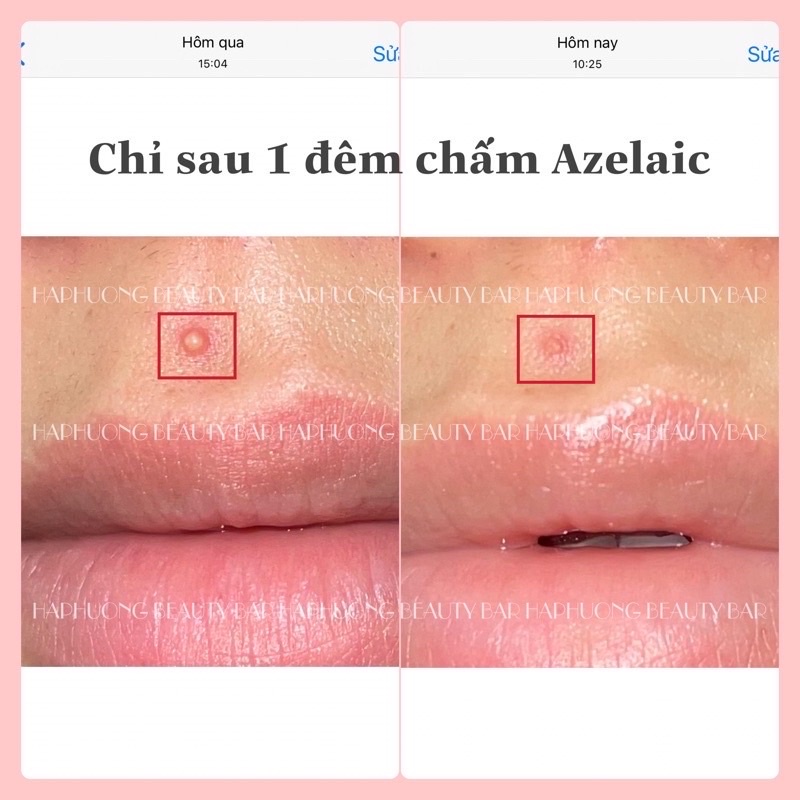 Kem Skinoren Azelaic Acid giảm mụn, thâm, nám bản nội địa Nga