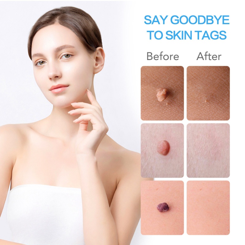 Bộ Dụng Cụ Loại Bỏ Mụn Cóc 2 Trong 1