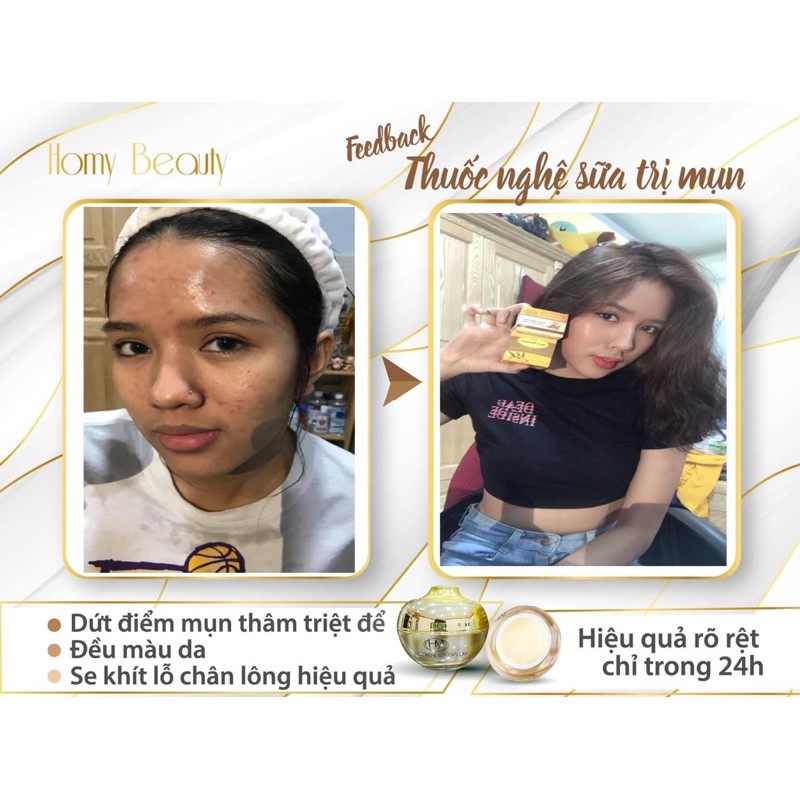 KEM NGHỆ SỮA GIẢM MỤN THÂM HOMY [ Cứu Tinh Cho Làn Da Mụn ] | BigBuy360 - bigbuy360.vn